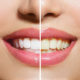 Гигиена зубов как способ профилактики заболеваний
