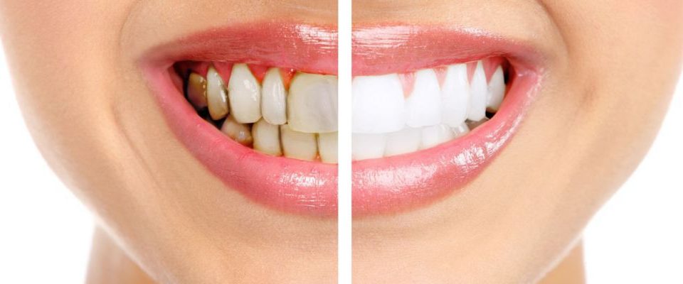 Гигиена зубов как способ профилактики заболеваний